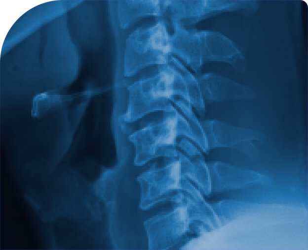 Imaging diagnosis of spine diseases