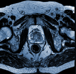 Prostate MRI – basic