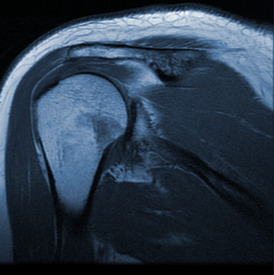 Shoulder MRI