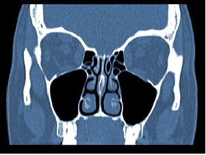 Paranasal sinuses and orbit