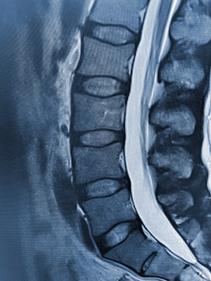 Spinal trauma interesting cases with key  concepts – CT and MR