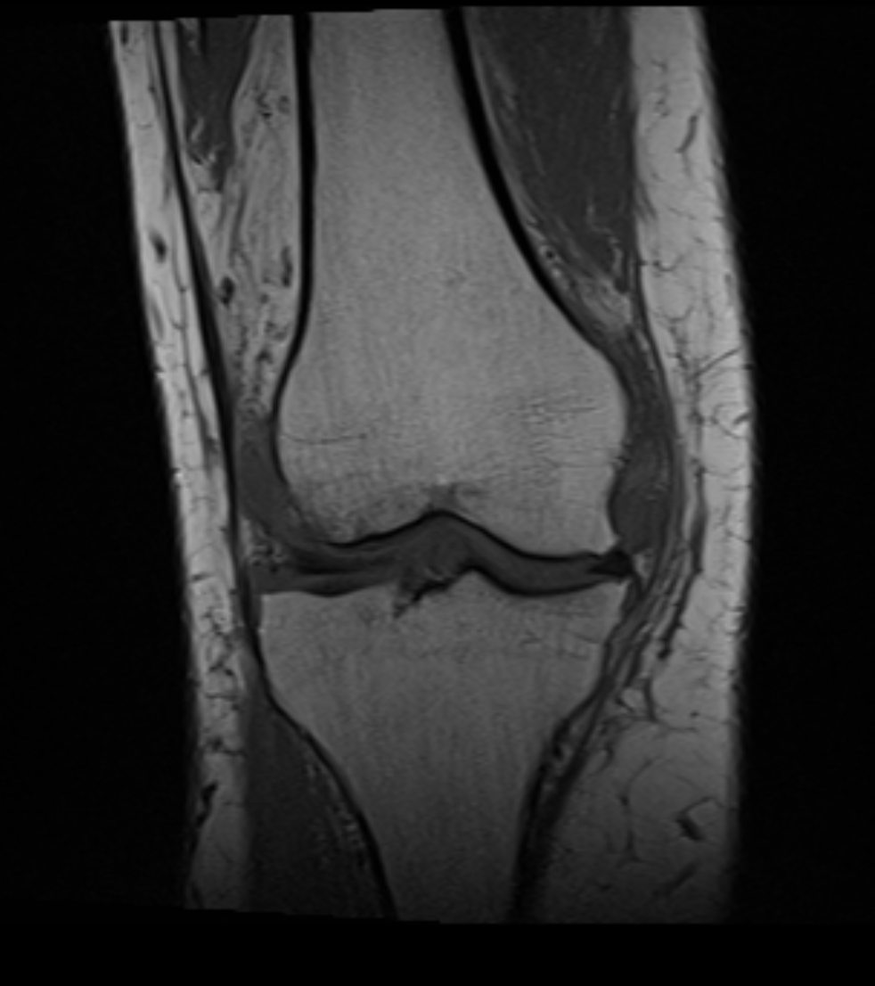 MRI kolano – średnio zaawansowany